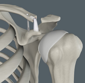 Acromioclavicular Joint Osteoarthritis