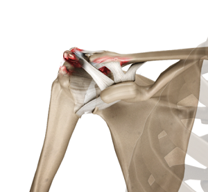 mask gallery Unpleasantly Acromioclavicular Joint Osteoarthritis Houston, TX | AC Joint Replacement  Surgery Houston, TX