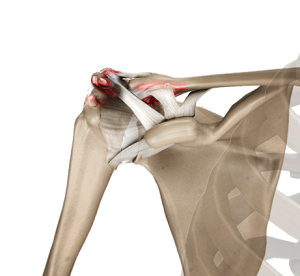 Acromioclavicular Joint Osteoarthritis