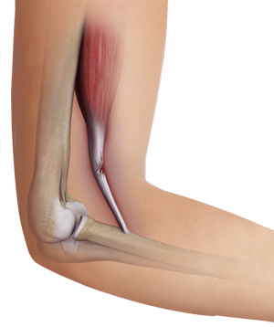 Bicep Tendon Tear at the Elbow