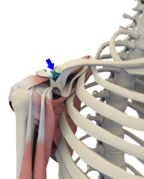 Distal Clavicle Excision