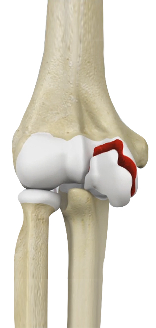 Distal Humerus Fractures of the Elbow