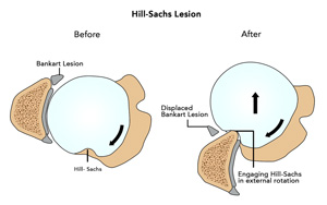 Hill-Sachs Lesion