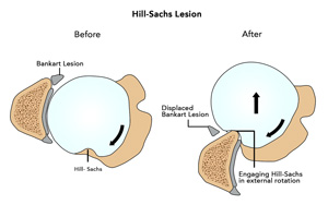 Hill-Sachs Lesion