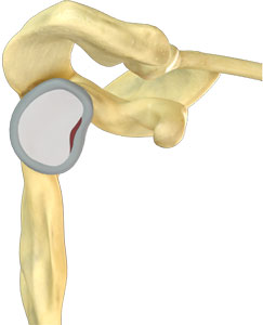 Labral Tear