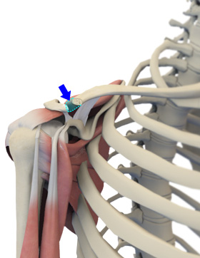 Mumford Distal Clavicle Excision