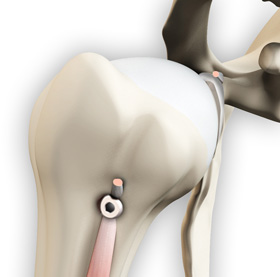 Proximal Biceps Tenodesis