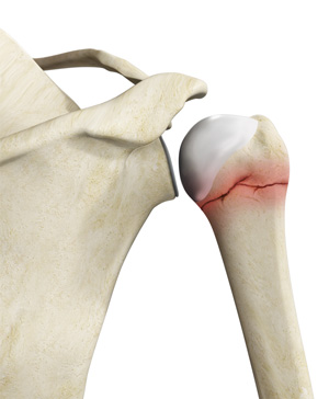 Proximal Humerus Fractures