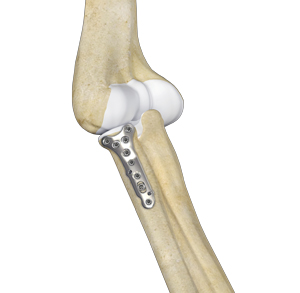 https://www.johnconwaymd.com/3d-images/radial-head-orif-and-replacement.jpg