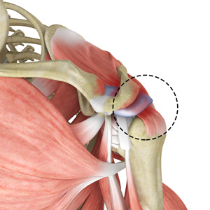 Rotator Cuff Pain