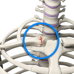 Sternoclavicular Joint (SC joint)