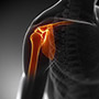 Massive Retracted Rotator Cuff Tear