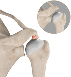 Subacromial Decompression