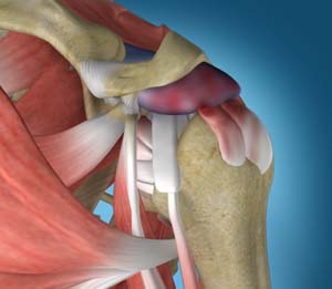 Internal Impingement of the Shoulder