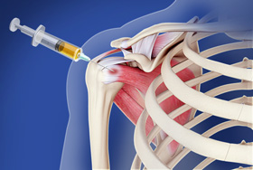 Intraarticular Shoulder Injection