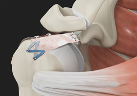 Superior Capsule Reconstruction